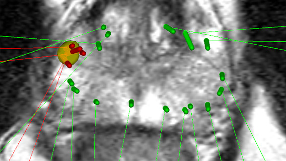 MRI Targeted Prostate Biopsy
