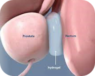 Rectal spacer placement