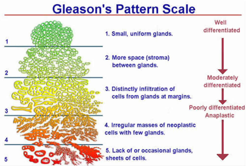 Picture of the Gleason pattern scale