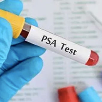 前立腺がん PSA 血液検査