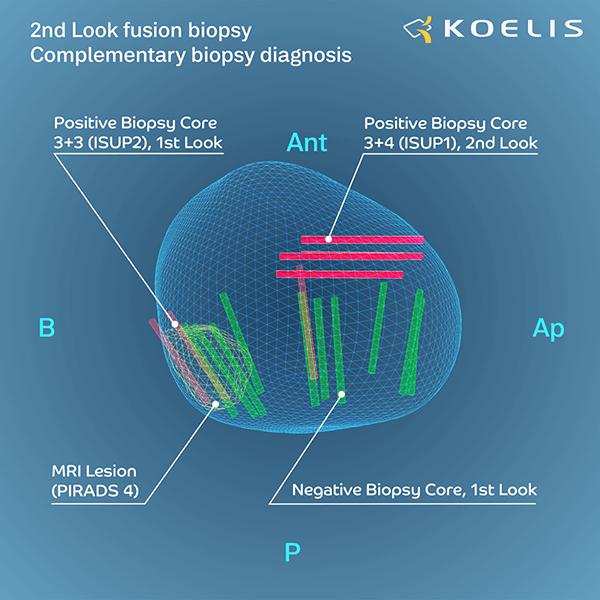 2nd Look Fusion | KOELIS