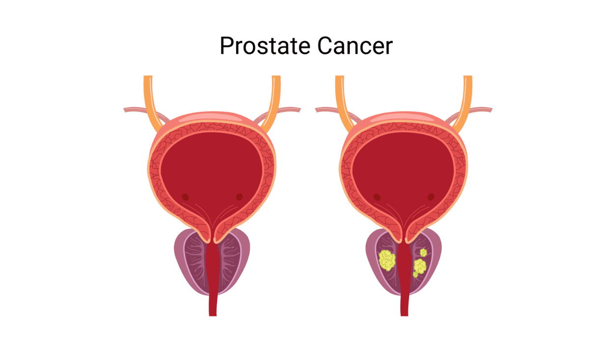 Prostate cancer. Tumor of the prostate gland. Comparison of a normal prostate gland and an enlarged prostate gland with cancer. Medical concept.