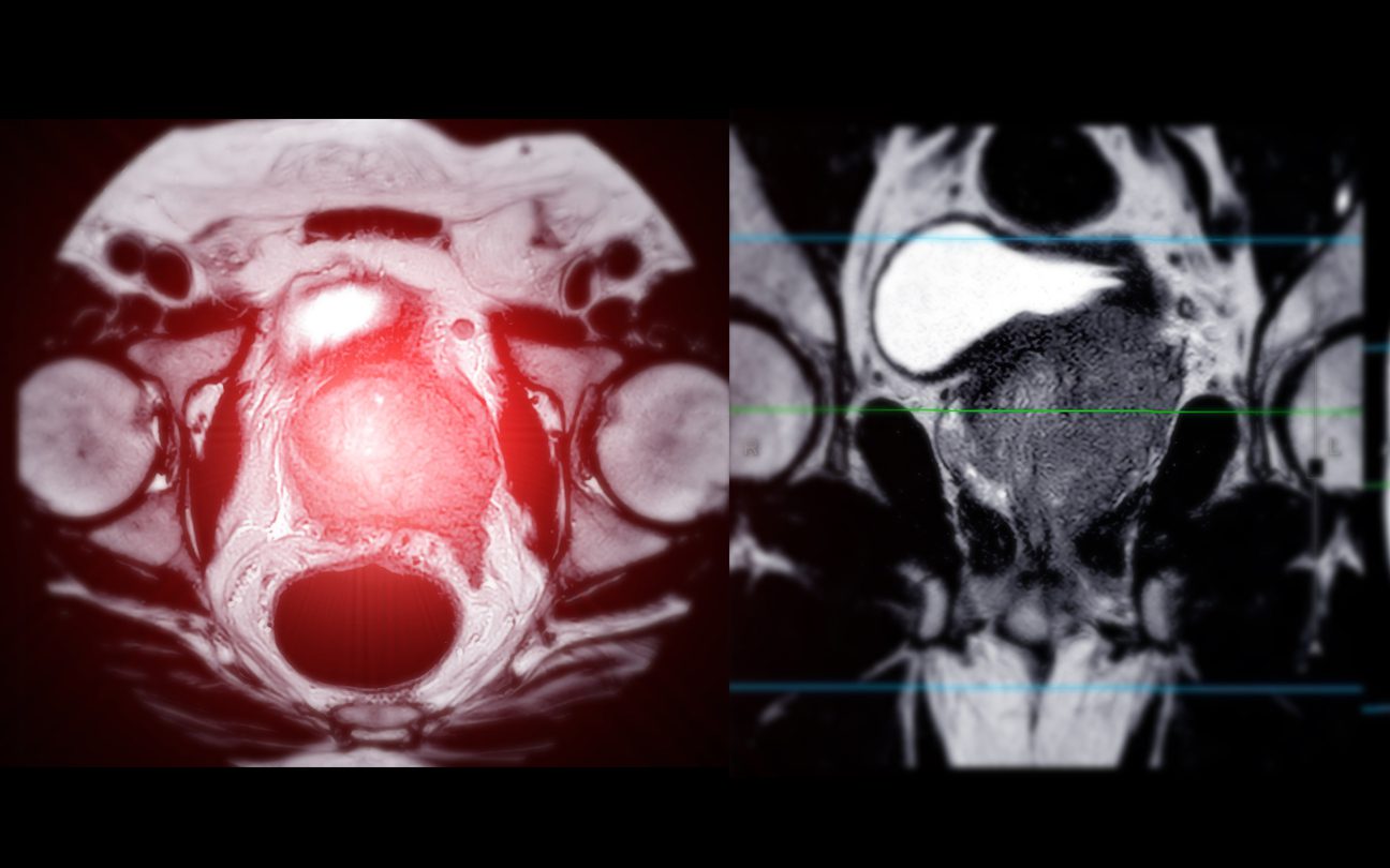 MRI of the prostate gland reveals a focal abnormal signal intensity (SI) lesion at the left posterolateral peripheral zones at the apex, aiding in diagnosing tumors and guiding treatment decisions.