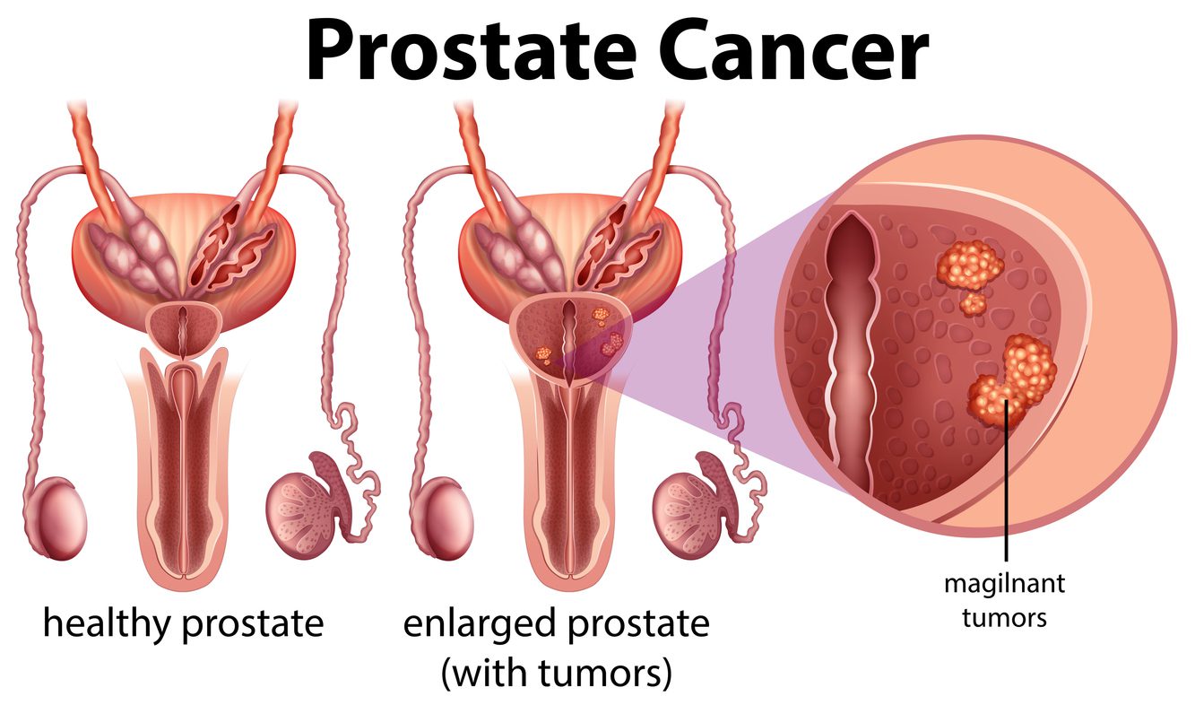 £1.8 Million Study to Test AI Tool That Could Transform Prostate Cancer Diagnosis on NHS