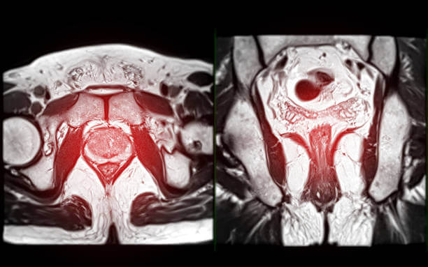 MRI of the prostate gland, revealing an enlarged size, aids in diagnosing tumors, guiding treatment decisions, and monitoring prostate health.