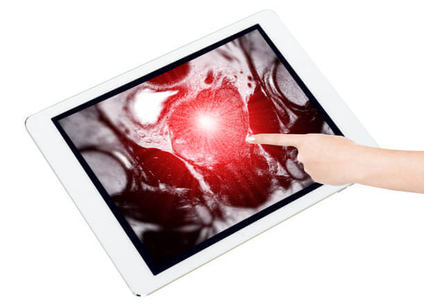 prostate on MRI